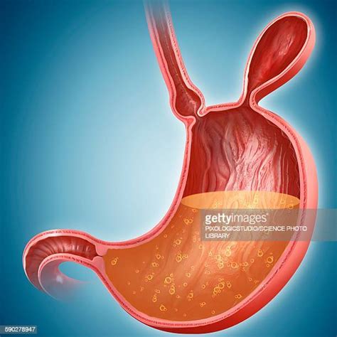 Hernia Illustration Photos And Premium High Res Pictures Getty Images