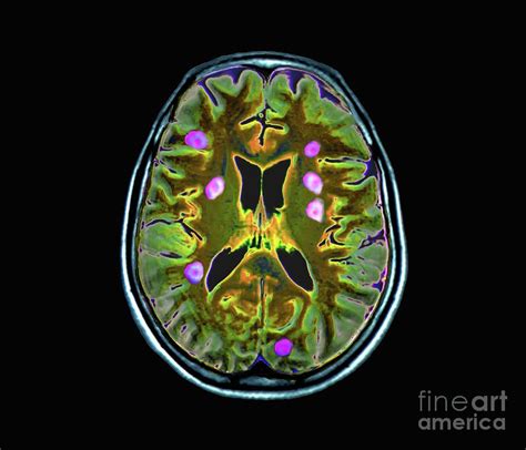 Secondary Brain Cancer Photograph By Zephyrscience Photo Library Pixels