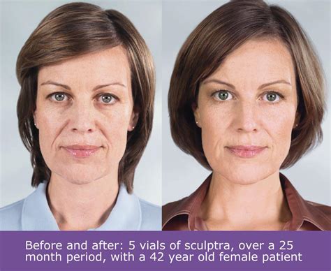 Sculptra Volumizing Aesthetic Medical Spa In Scarsdale Ny