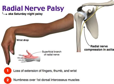 Rosh Review Radial Nerve Palsy Neuro Nsdbn Nerve Palsy Radial