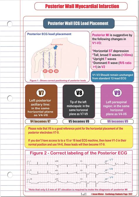 Ecg Educator Blog Posterior Ecg Lead Placement