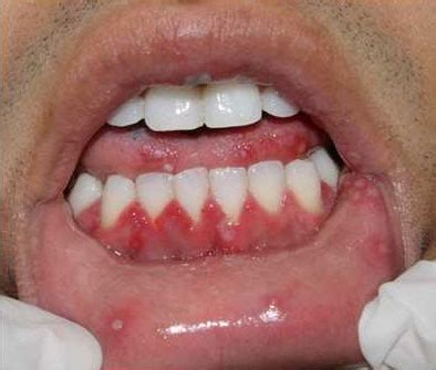 Herpetic Stomatitis Pictures