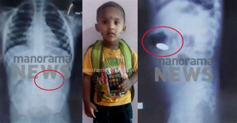 Three Year Old Dies After Swallowing Coin Health Minister Orders Probe Kerala News Manorama