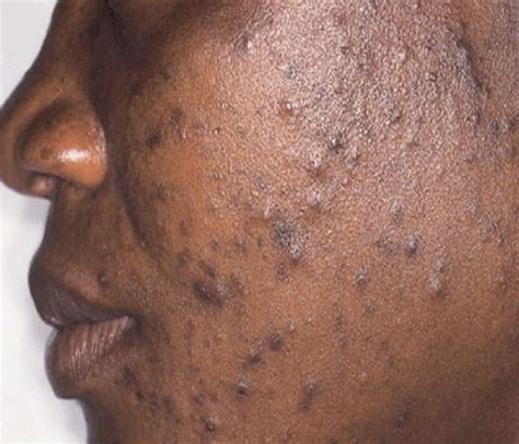 Pimples Acne Causes Symptoms Treatment Diagnosis And Prevention