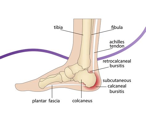 Haglund S Deformity Causes Symptoms Treatment The Feet People