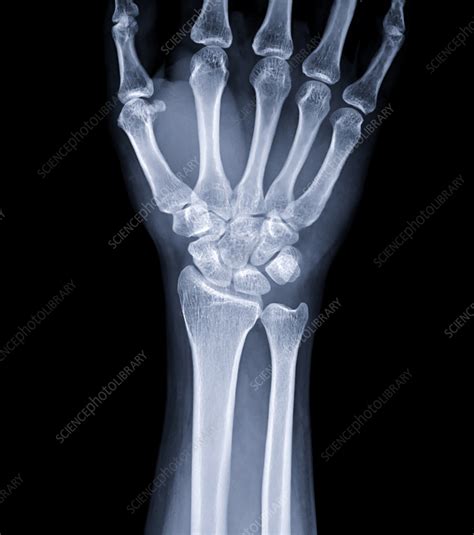 Healthy Wrist X Ray Stock Image F0375163 Science Photo Library