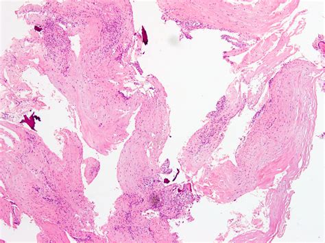 Ganglion Cyst Pathology