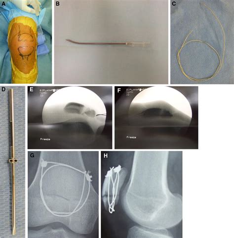 Percutaneous Cerclage Wiring For The Surgical Treatment Of Displaced