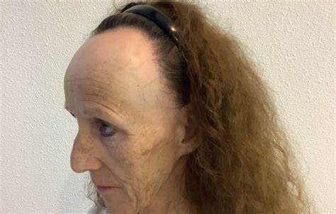 Frontale Fibroserende Alopecia Wat Is Het En Is Behandeling Mogelijk