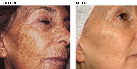 Can Ipl Treatments Cause Hyperpigmentation Justinboey