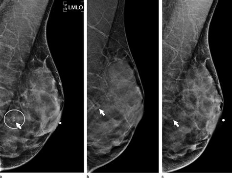 Images In A 52 Year Old Woman Who Was Noted To Have An Asymmetry
