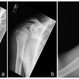 Axillary view of case 2 demonstrating avulsion fracture of ...