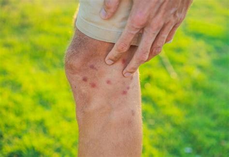 How To Prevent And Treat Sand Flea Bites A Complete Guide Exotella