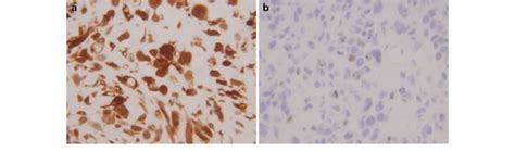 P16 Immunohistochemistry And Rna In Situ Hybridization A P16 Positive