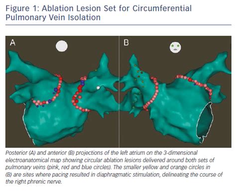 Figure 1 Ablation Lesion Set For Circumferential Pulmonary Vein