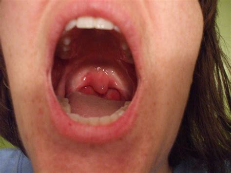Uvula Swollen Causes Symptoms Treatment Remedies Healthmd