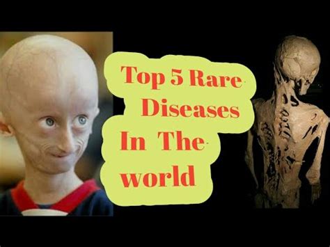 Top 5 Rare Disease In The World Exclusive See That You Do Not