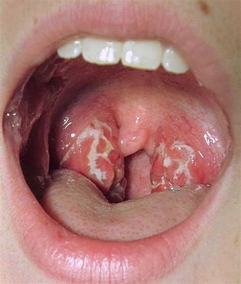 Strep Throat Streptococcal Pharyngitis Is A Disease That Causes A