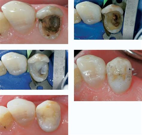 Decay On Upper Premolar A Tooth Isolated With Sectional Matrix In