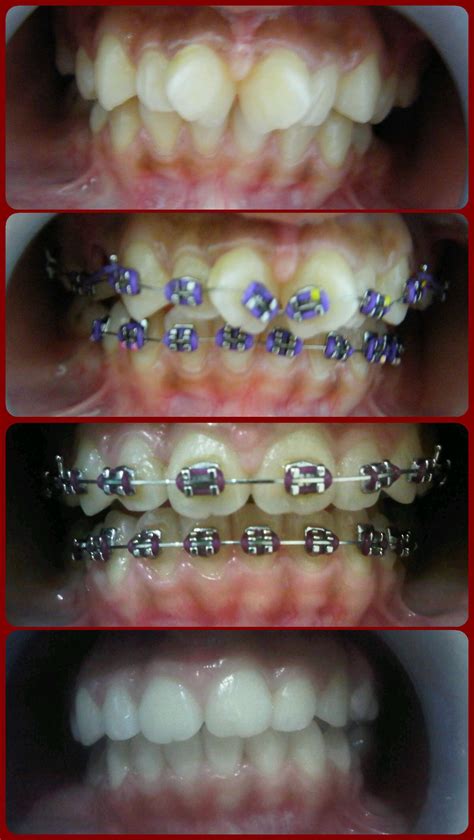Pin De Drghnanang Firmansyah Em Braces Aparelho Ortodontico Ortodôntico Grills Dentes