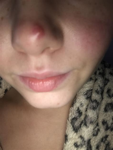 Help Huge Red Pimple On My Nose For 6 Weeks General Acne