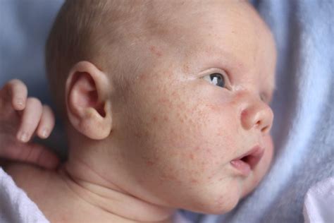Newborn Baby Acne Causes And Treatment