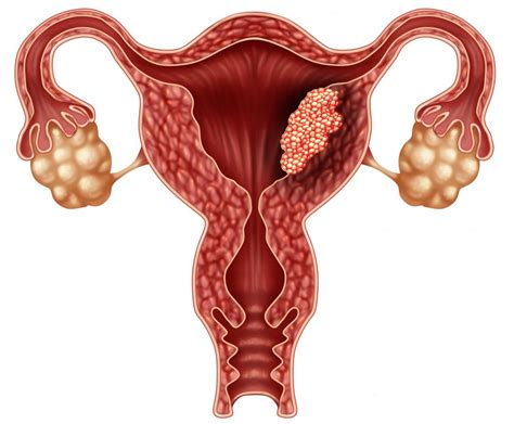 Is there an association between menopause and uterine cancer? Endometrial cancer: Symptoms, staging, treatment, and causes