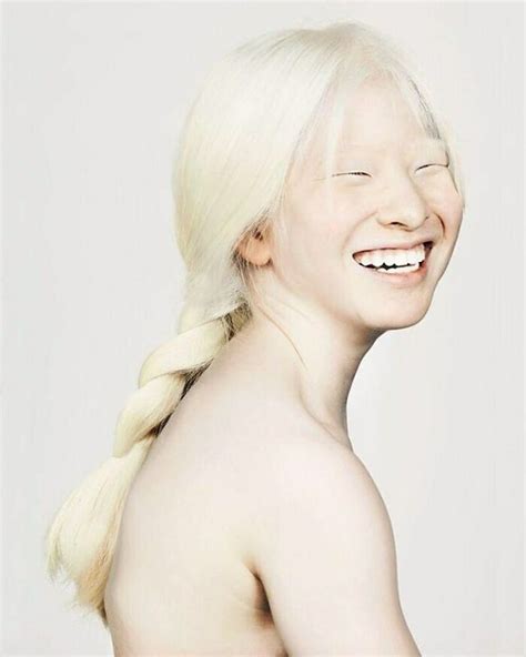 Albino Girl Gets Abandoned As A Baby Grows Up To Become A Vogue Model Pics DeMilked