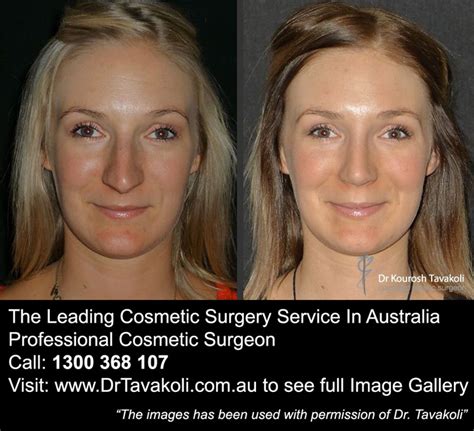 Nose Job Tip Refinement Before And After The Leading Cosmetic Surgery Service In Australia
