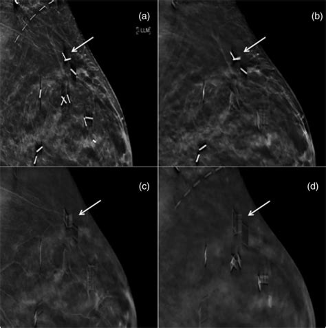 Digital Breast Tomosynthesis Image Acquisition Principles And