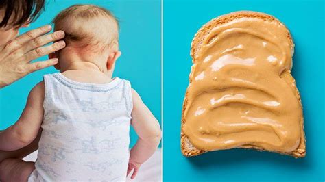 Allergy Trigger What Are The Symptoms Of A Peanut Butter Allergy