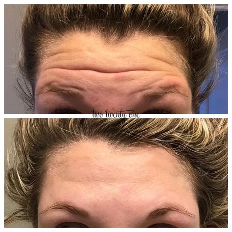 How often to get botox for frown lines. Botox Before and After - My Botox Experience