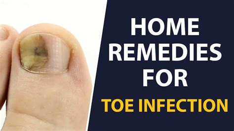 Home Remedies To Get Rid Of A Toe Infection Fast Remedies For A Toe