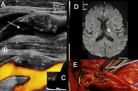 Case 3 Carotid Ultrasonography B Mode Imaging A Of The Internal