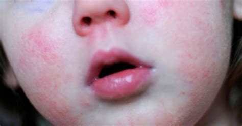Scarlet Fever Rash Without Other Symptoms Study For Medicine Medical