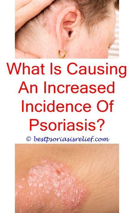 Biologicsforpsoriasis Mild Scalp Psoriasis Pictures Psoriasis And