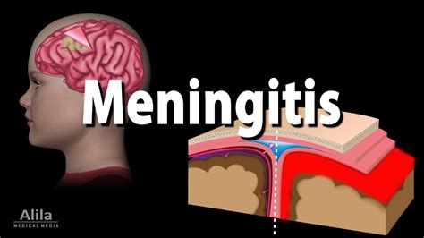 Meningitis Pathology Causes Symptoms Diagnosis And Treatment