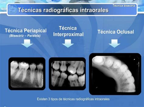 Tecnica De Bisectriz