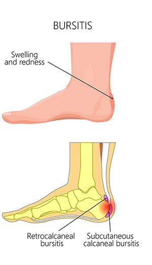 Bursitis Foot Health Patients Apma