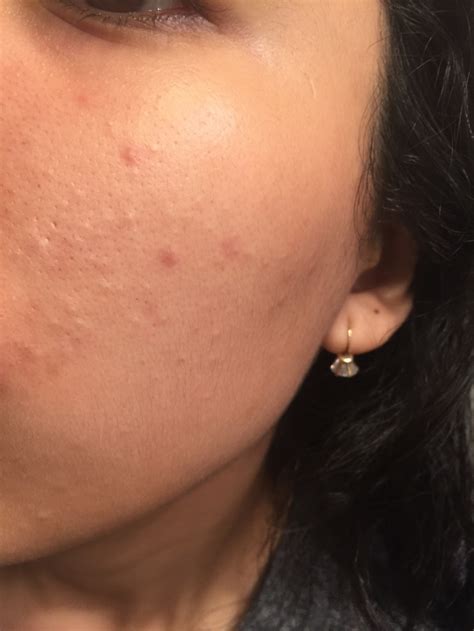 How Do You Get Rid Of Stubborn Closed Comedoneshelp General Acne