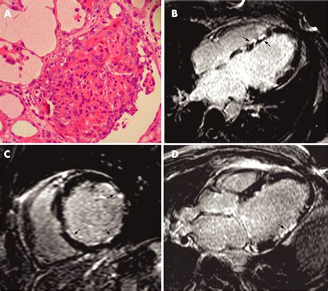 Cardiomyopathy Associated With Wegeners Granulomatosis Bmj Case Reports