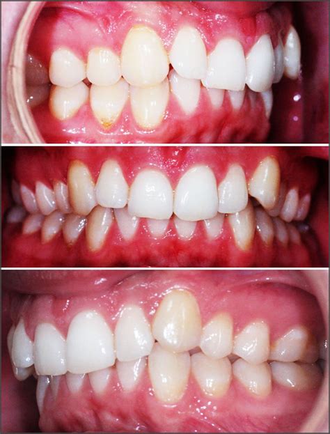 Class Ii Division 2 Malocclusion Patient Measured With T Scan Digital