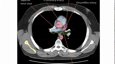 Anatomy Of A Transverse Ct Of The Thorax Youtube