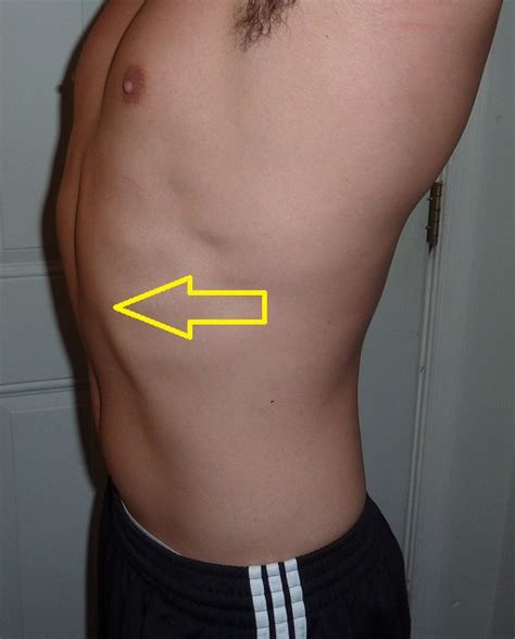 Rib Cage Flare Proven Ways To Fix Flared Ribs Without Surgery In I Learned About