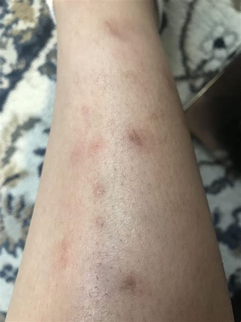 Skin Concerns Help Stubborn Brown And Red Marks From Mosquito Bites