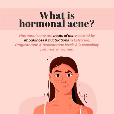 Hormonal Acne The What Why And The Remedy