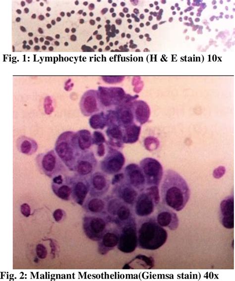 Table 5 From Study Of Pleural Fluid Cytology In A Tertiary Care