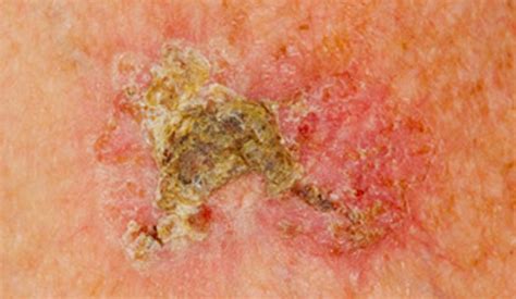 Actinic Keratosis Pictures Causes And Treatment