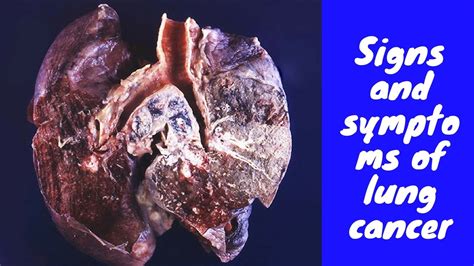 This condition can occur in one or both lungs and can affect a person of this momjunction post gives you essential details about the signs of lung cancer in children, and its causes, diagnosis, and treatment. Signs and symptoms of lung cancer - YouTube