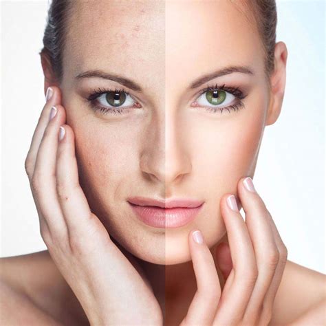 Ipl Photofacial Skin Rejuvenation Toronto Vs Medspa